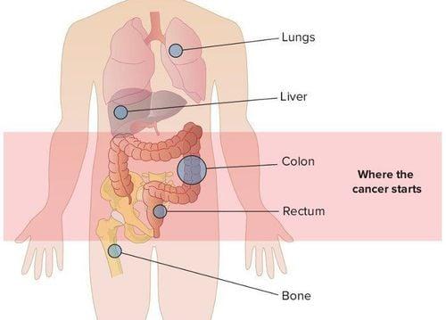 Di căn phát triển khi các tế bào ung thư tách ra khỏi khối u chính và xâm nhập vào hệ thống máu