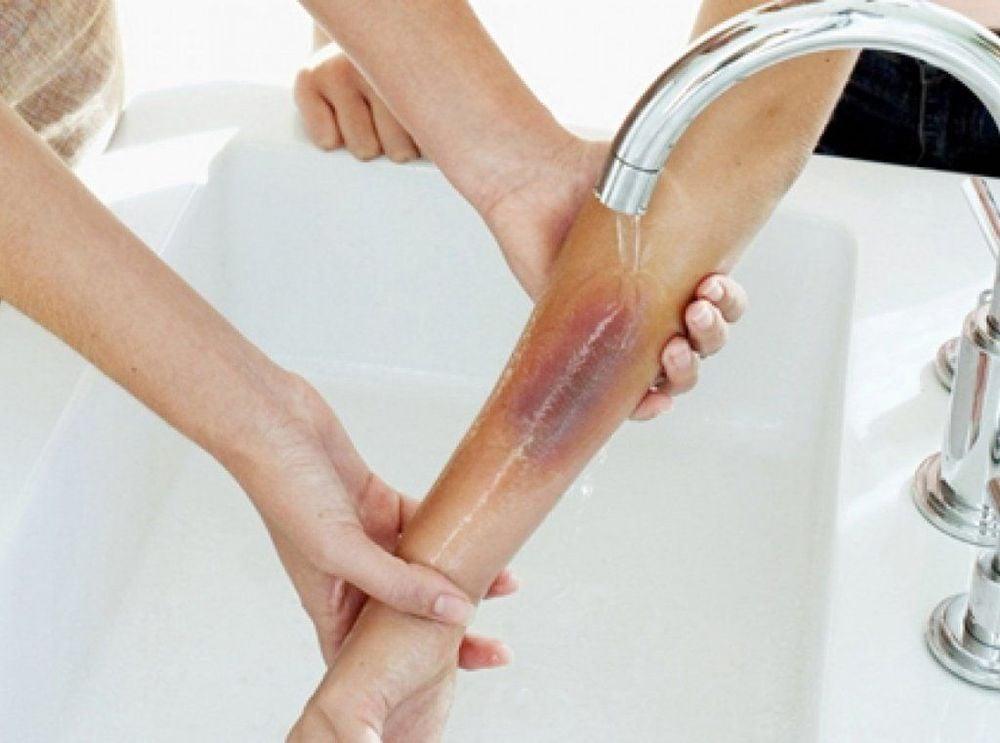 Cần sơ cứu bỏng bô, bỏng nhiệt kịp thời giúp giảm tối đa nguy cơ biến chứng do bỏng gây ra